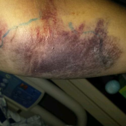 Val Conley during hospital stay — May 2016 pulmonary embolism