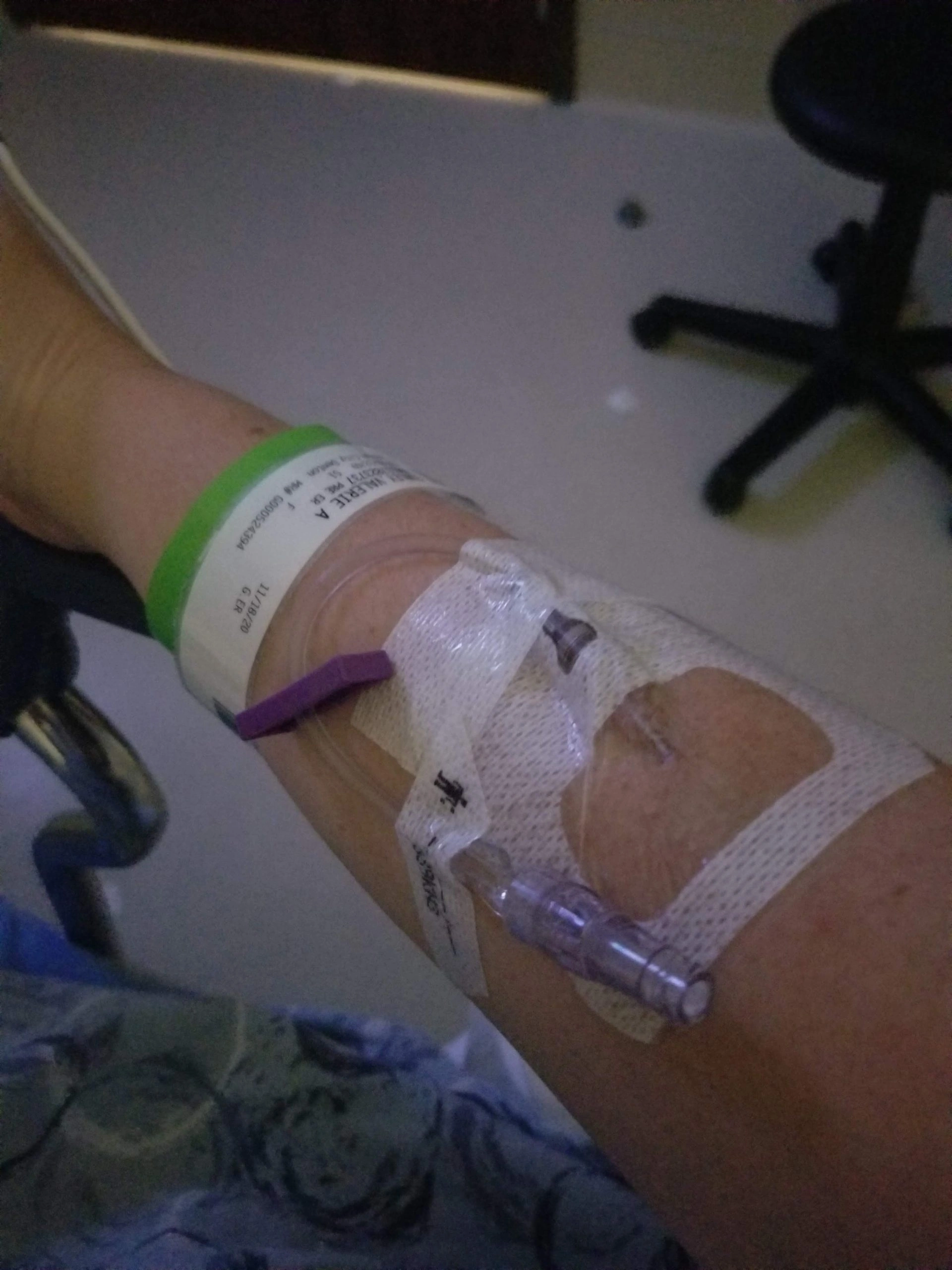 Hospital IV line for PE treatment